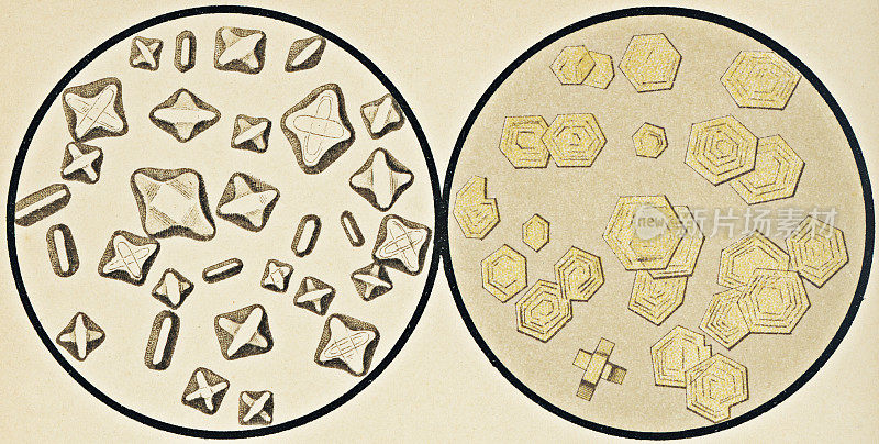 显微镜观察磷酸镁和胱氨酸晶体从尿沉渣- 19世纪